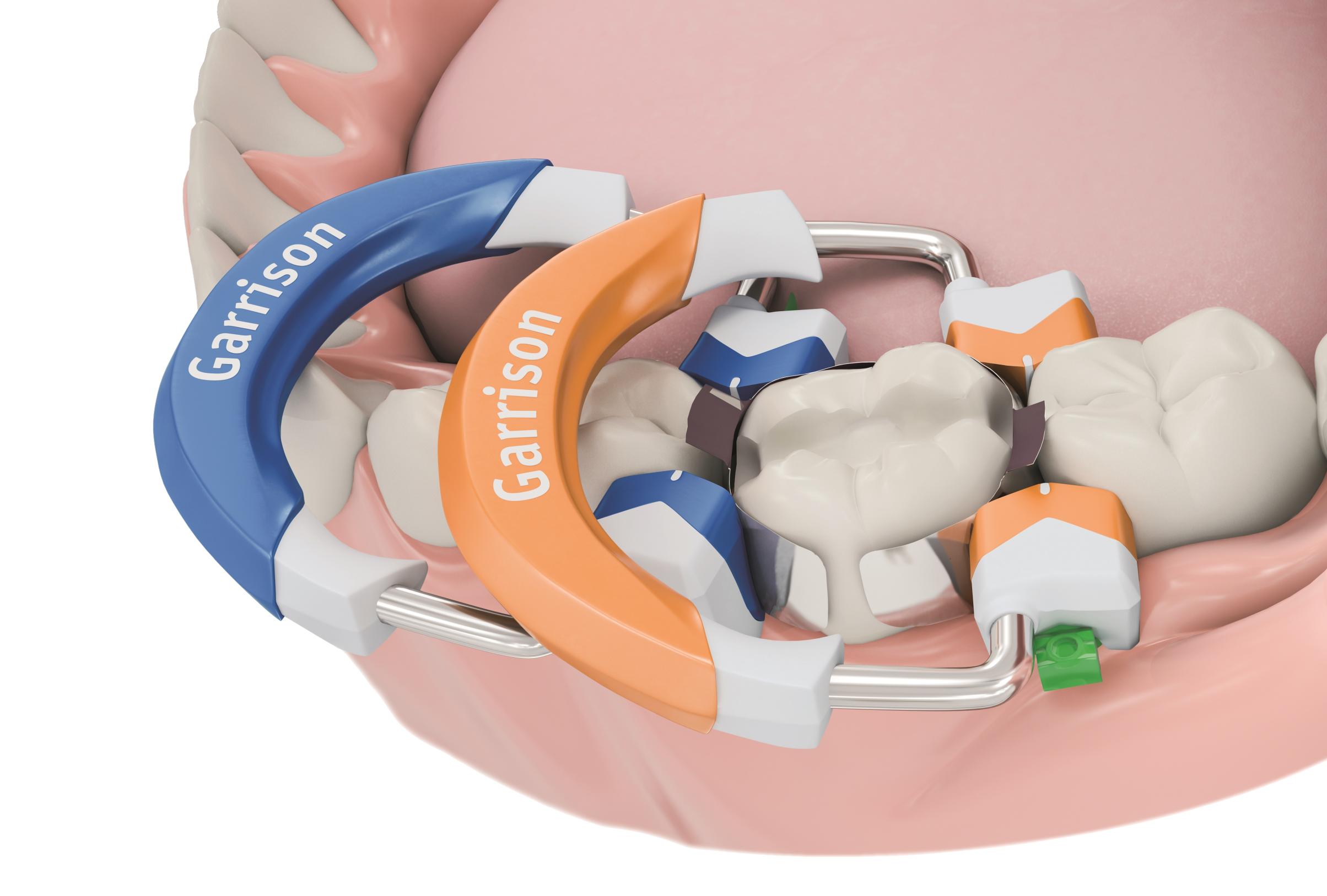 Composi-Tight 3D Fusion Sectional Matrix System with Rally